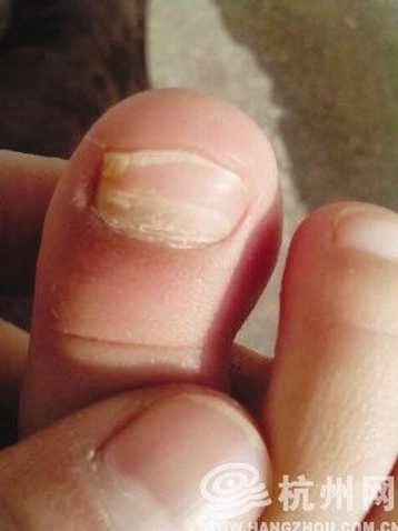 杭州一家民办甲级幼儿园中有多名儿童出现指甲外翻,脱落的情况,家长一